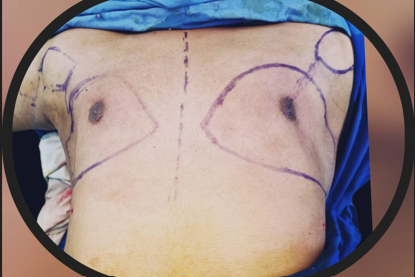 Gynecomastia surgery - After