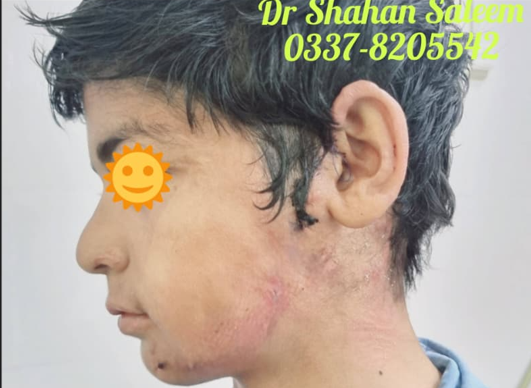 Scar Revision Burn - After