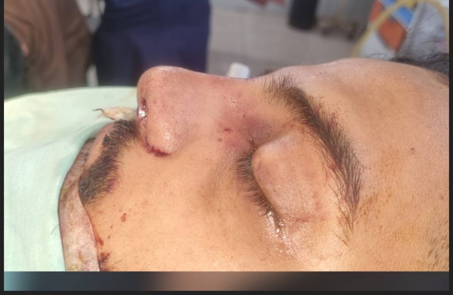 Rhinoplasty - After
