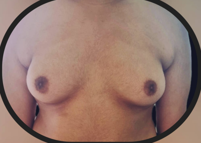 Gynecomastia surgery - Before