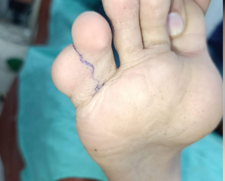 Syndactyly - Before