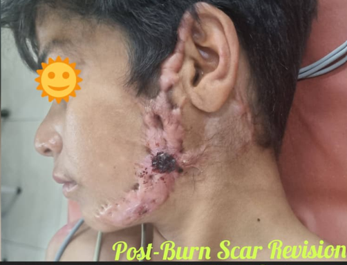 Scar Revision Burn - Before