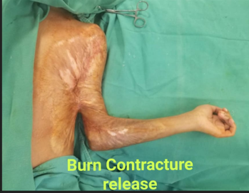 Axillary Contracture - Before