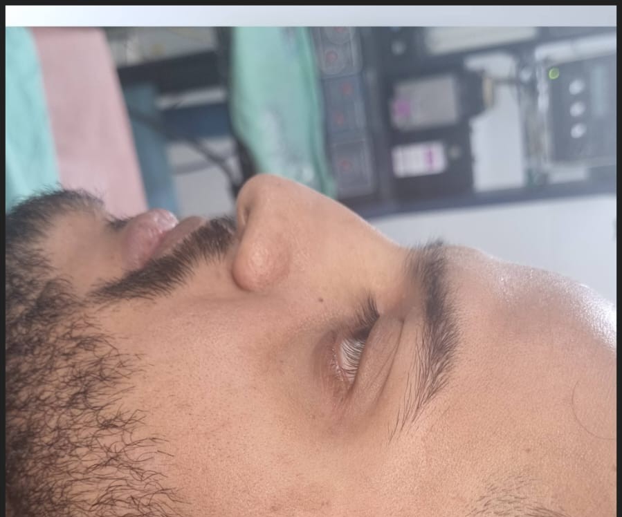 Rhinoplasty - Before