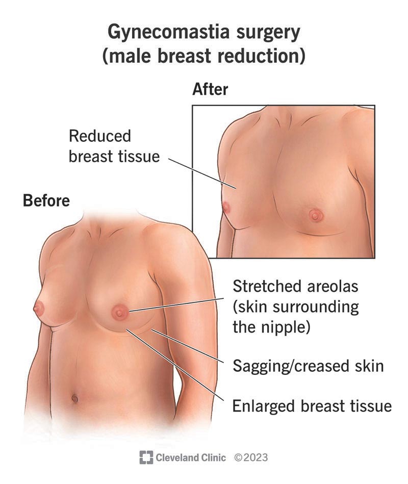 Gynecomastia Surgery
