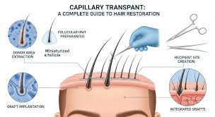 Hair Transplant