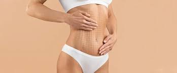 Tummy Tuck