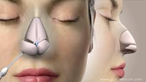 Rhinoplasty (Nose Surgery)