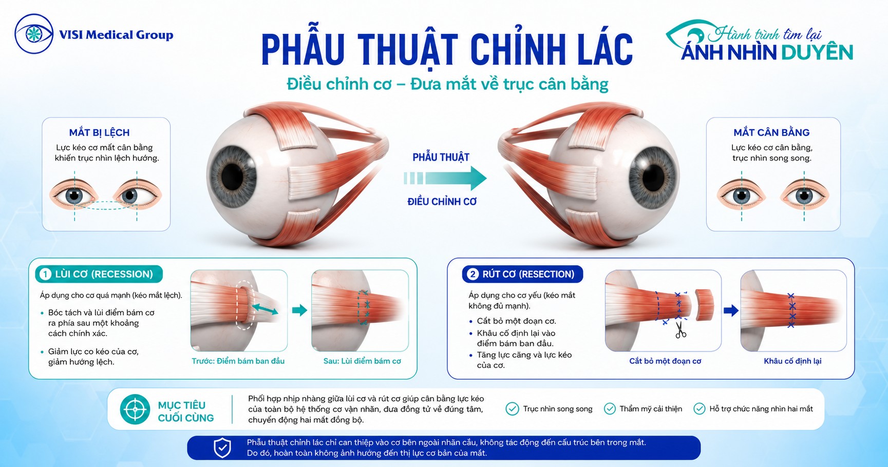 Cơ chế điều chỉnh lùi cơ và rút cơ vận nhãn trong phẫu thuật mổ lác