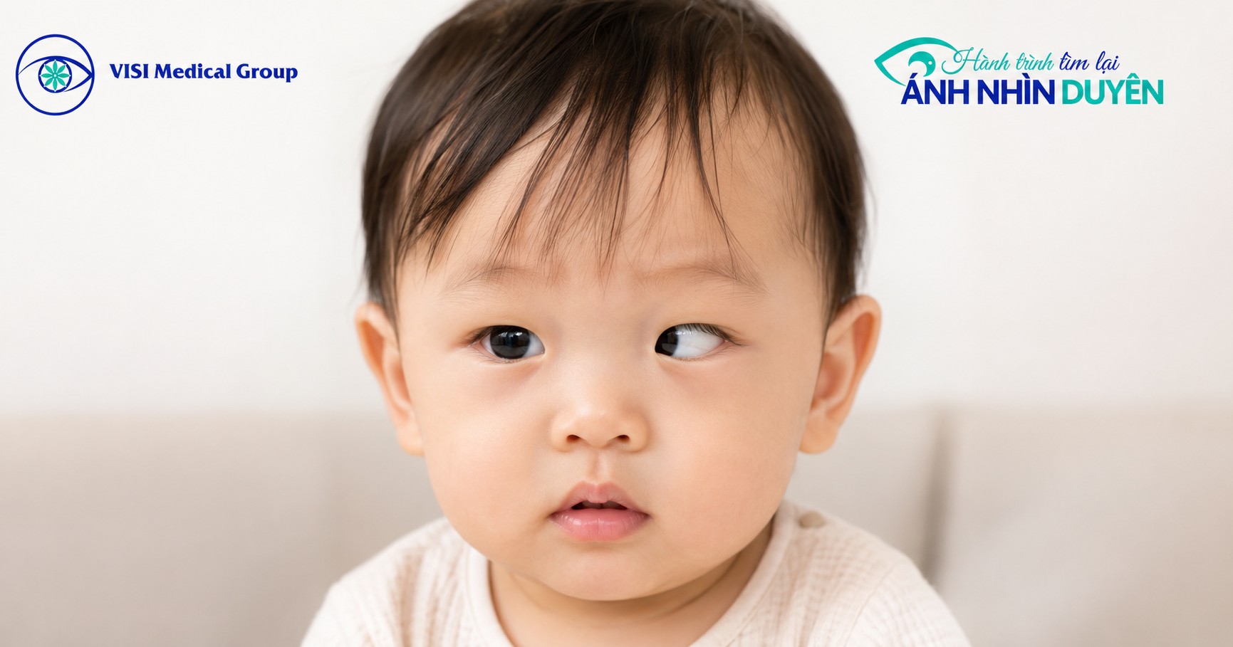Trẻ nhỏ có dấu hiệu mắt bị lệch trục hoặc tư thế đầu nghiêng bất thường do bệnh lác mắt.