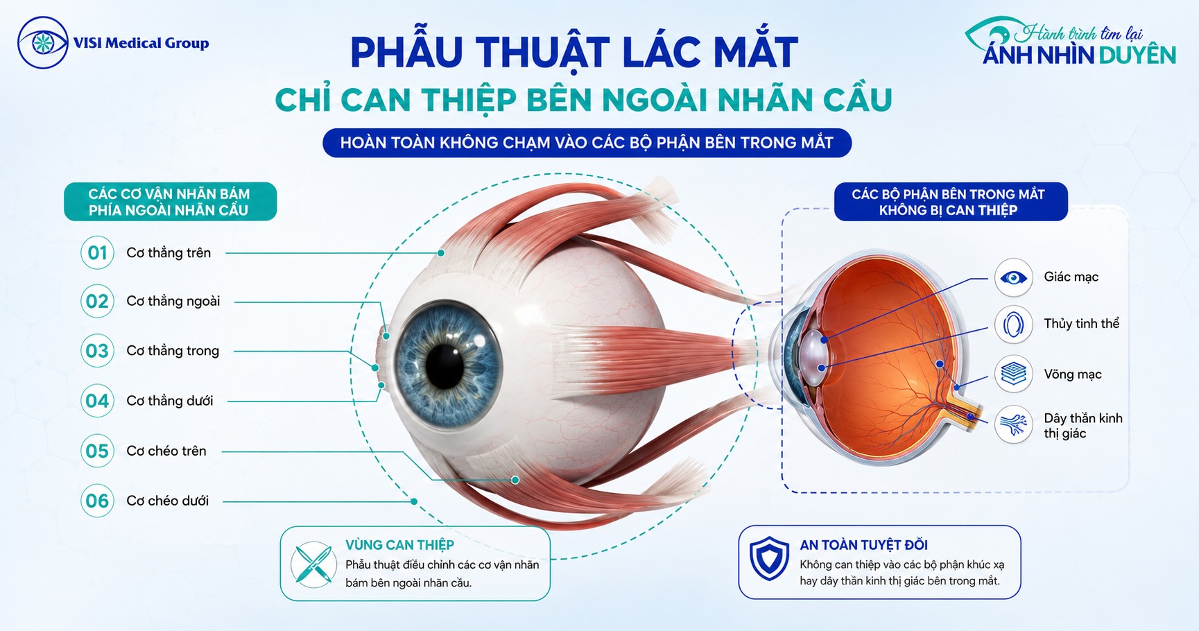 Kỹ thuật mổ chỉnh lác chỉ can thiệp hệ thống cơ bám ngoài nhãn cầu an toàn tuyệt đối