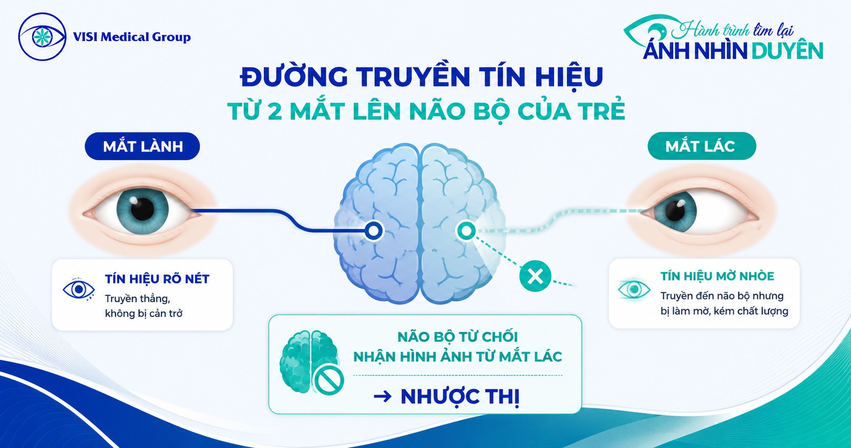 Những hệ lụy nghiêm trọng về thị lực và tâm lý do bệnh lác mắt ở trẻ em gây ra