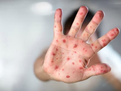 В Дагестане продолжают регистрировать случаи заболевания корью