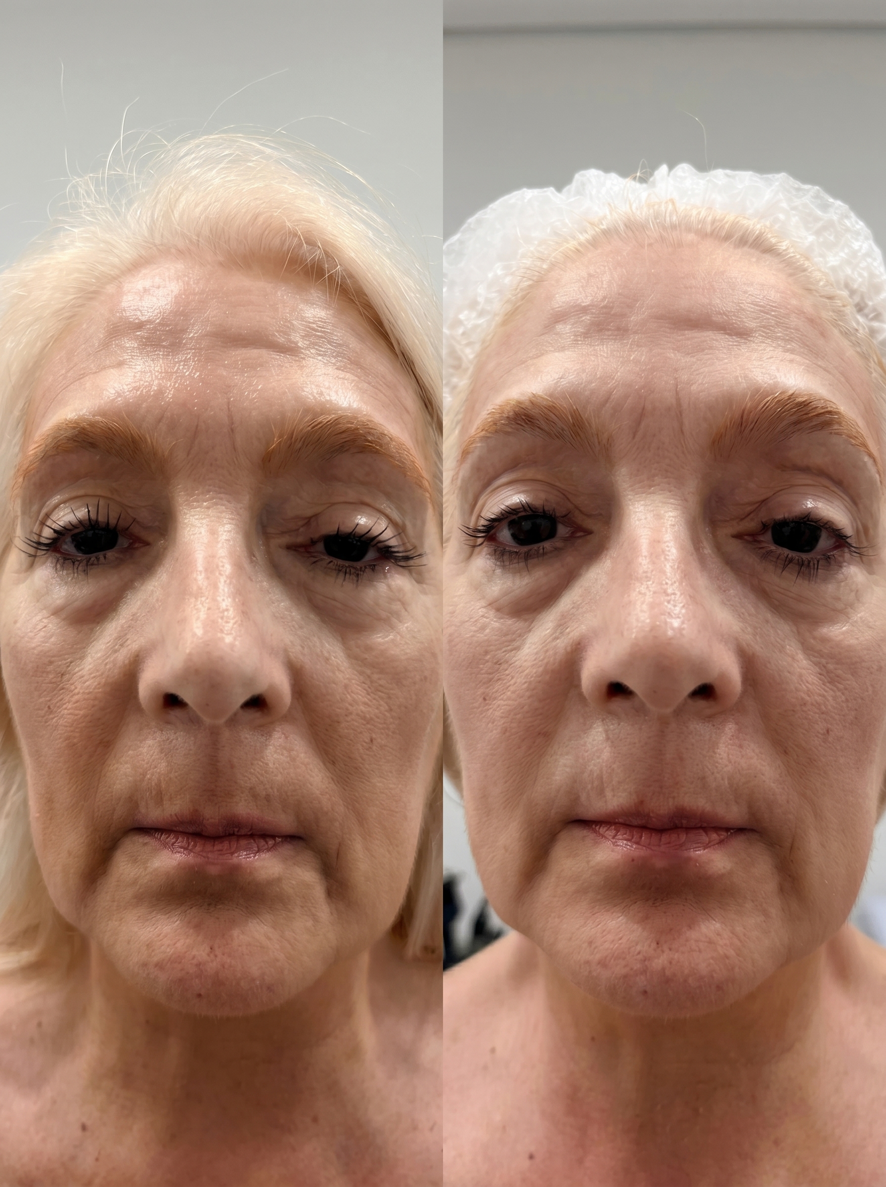 Resultado de tratamento HIFU Sónia Dolbeth
