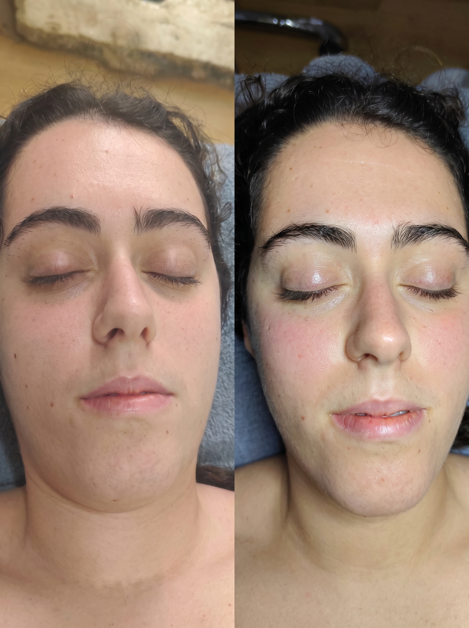 Resultado de tratamento facial na Sublime, esteticista Setúbal