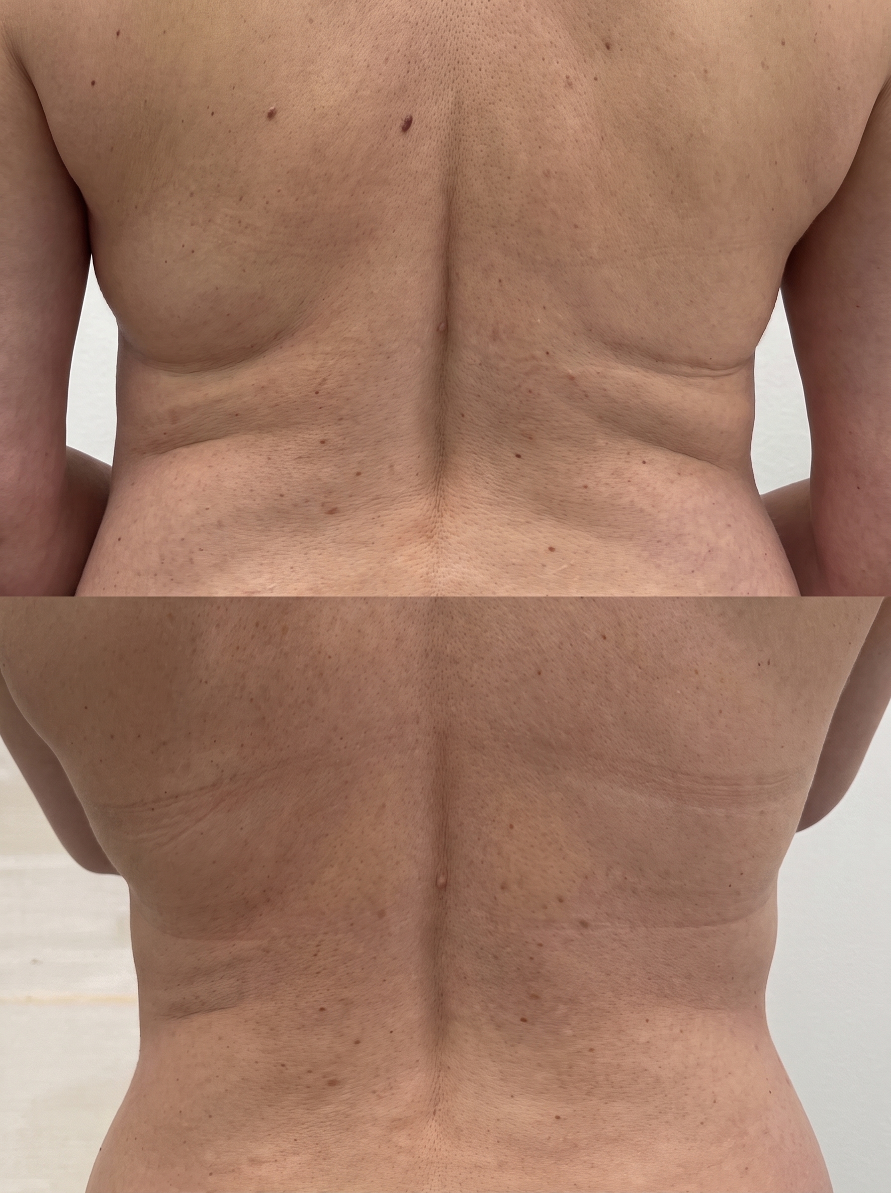 Botox e rejuvenescimento facial na Victory Clinic em Trofa com resultados naturais