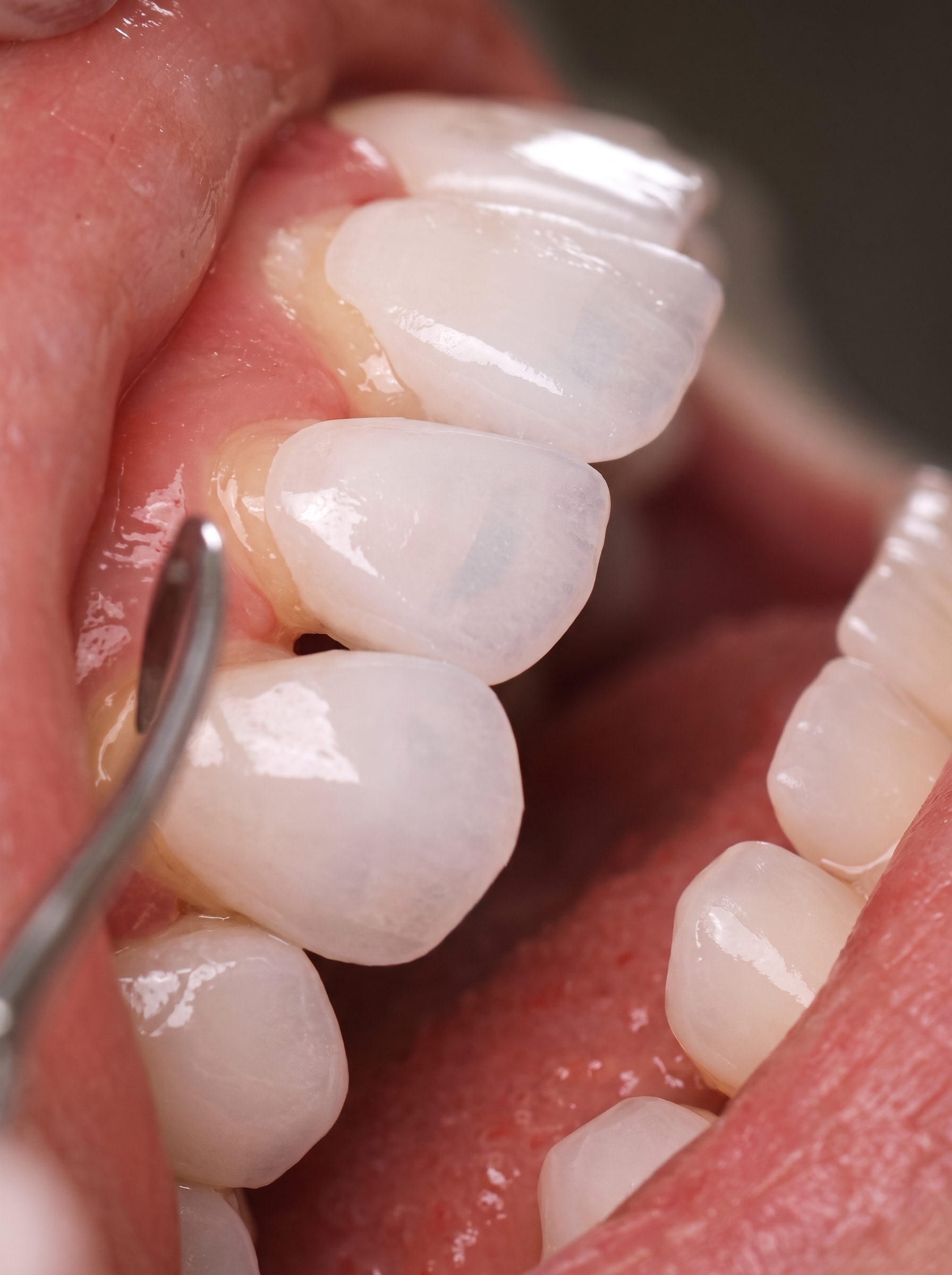 Resultados de facetas e implantes dentários no Instituto Face e Vida Rio Tinto