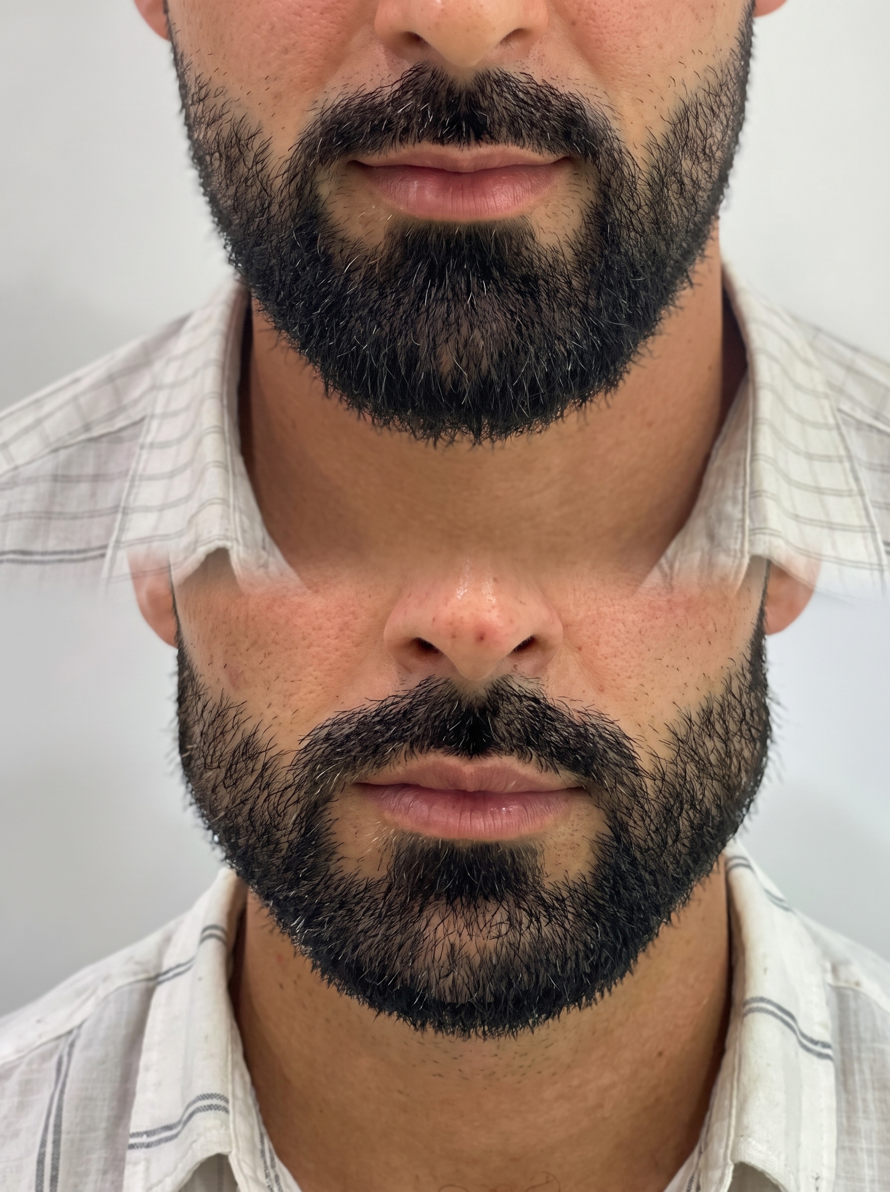 Preenchimento com ácido hialurónico na Pellem Aesthetics, Quarteira