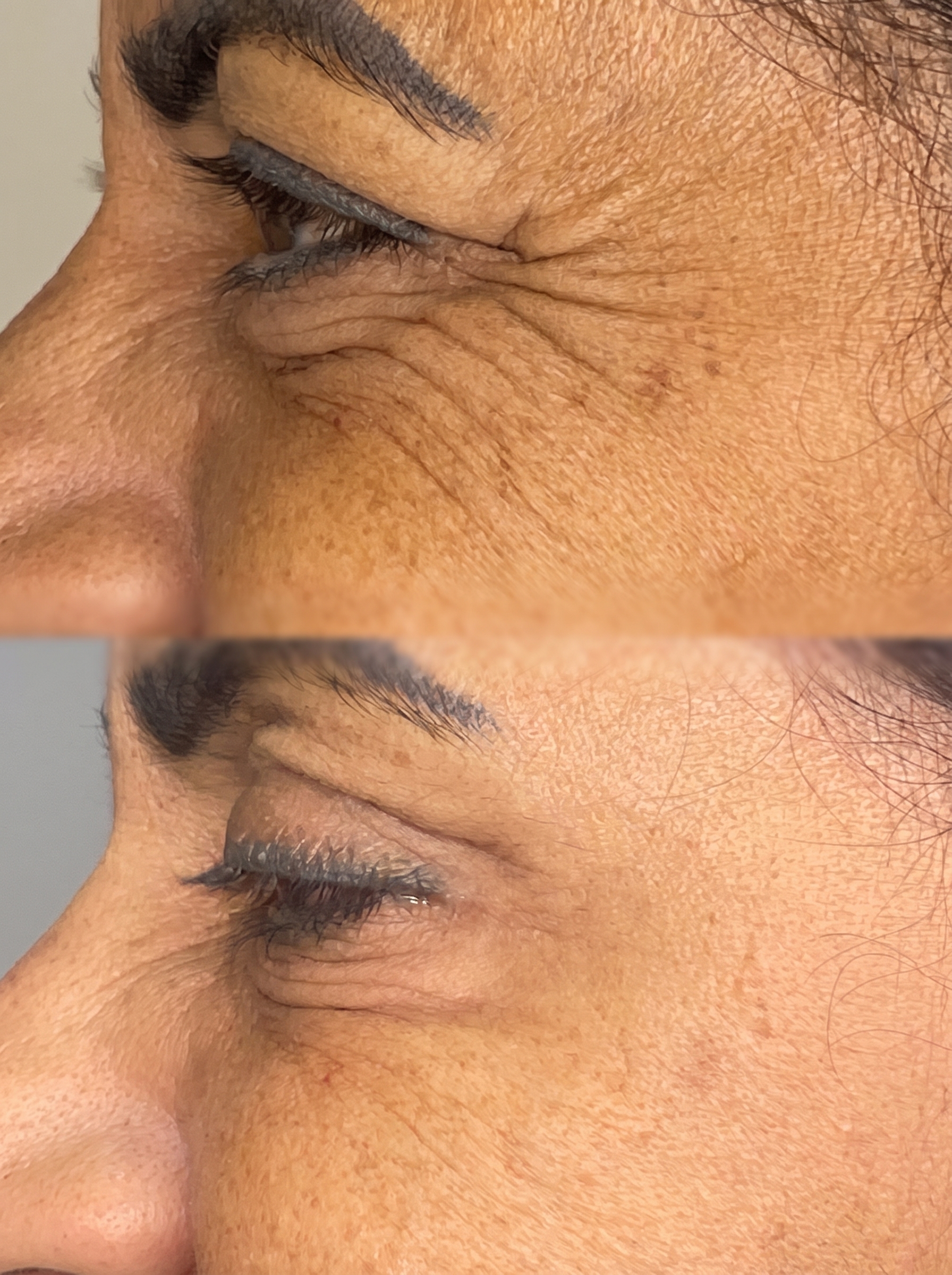 Botox e toxina botulínica na Pellem Aesthetics em Quarteira, Algarve