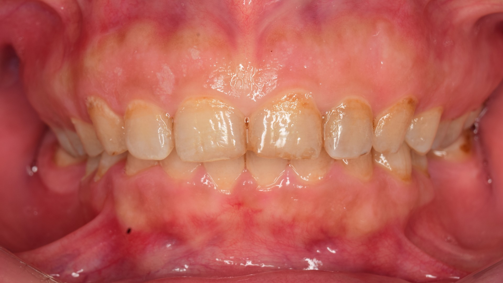 Gummy Smile? Picture