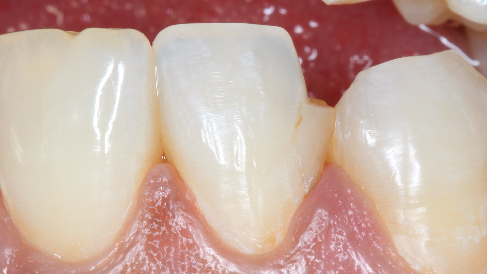 Composite fracture Picture