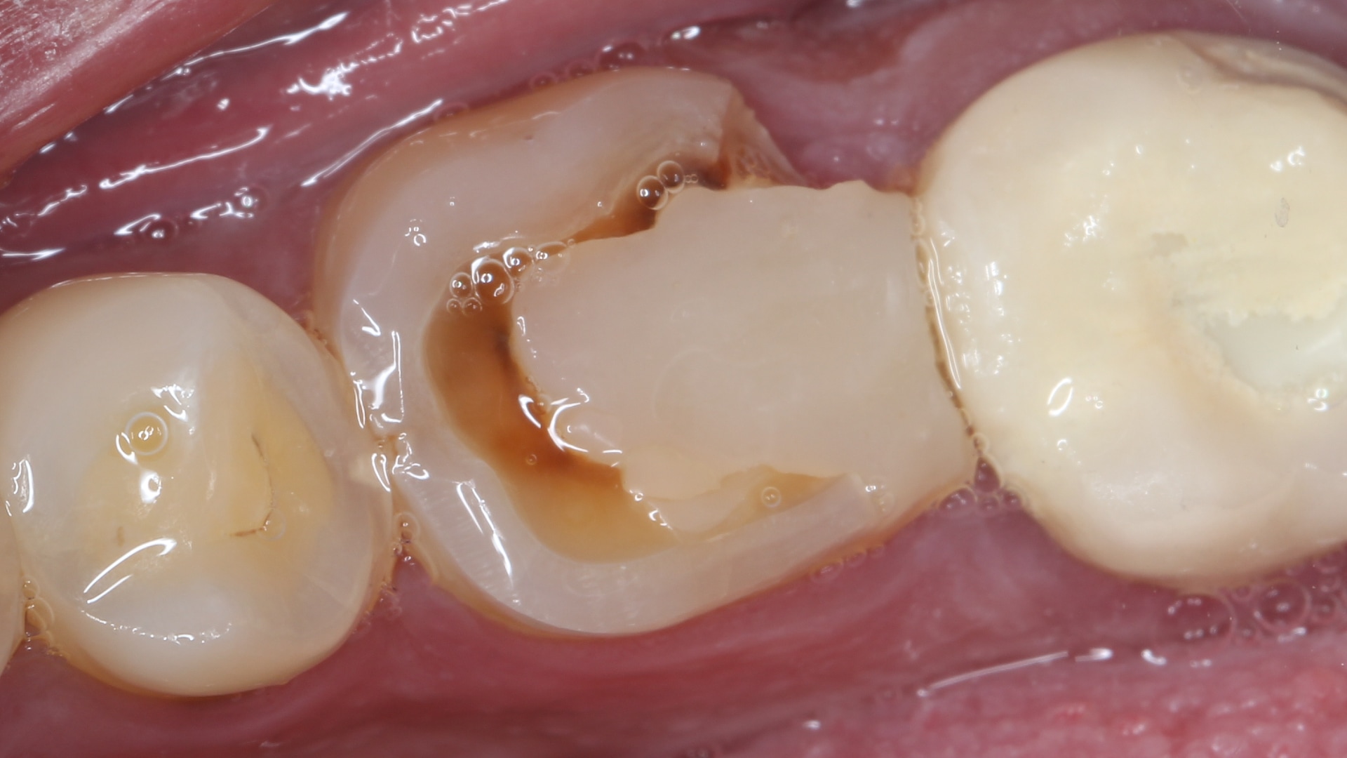 Faulty composite replacement Picture