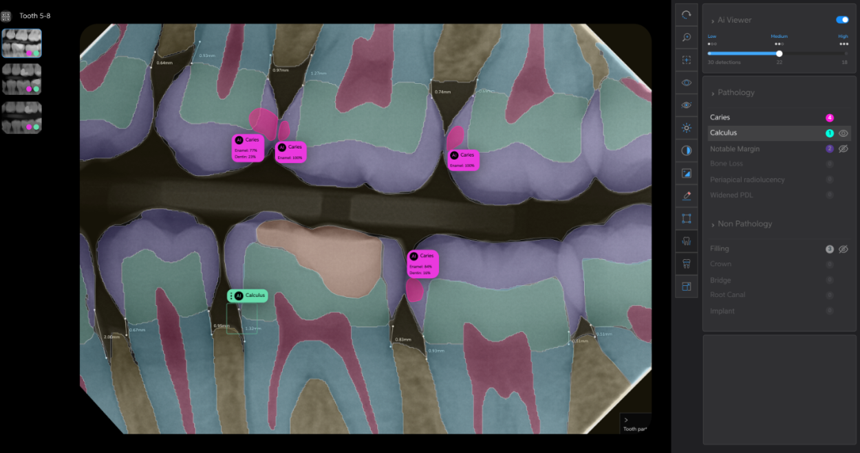 Is AI the New Standard for Detecting Dental Caries? Picture
