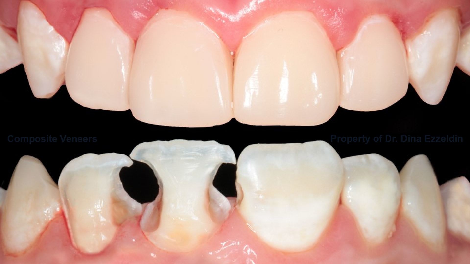 Composite Veneers Picture