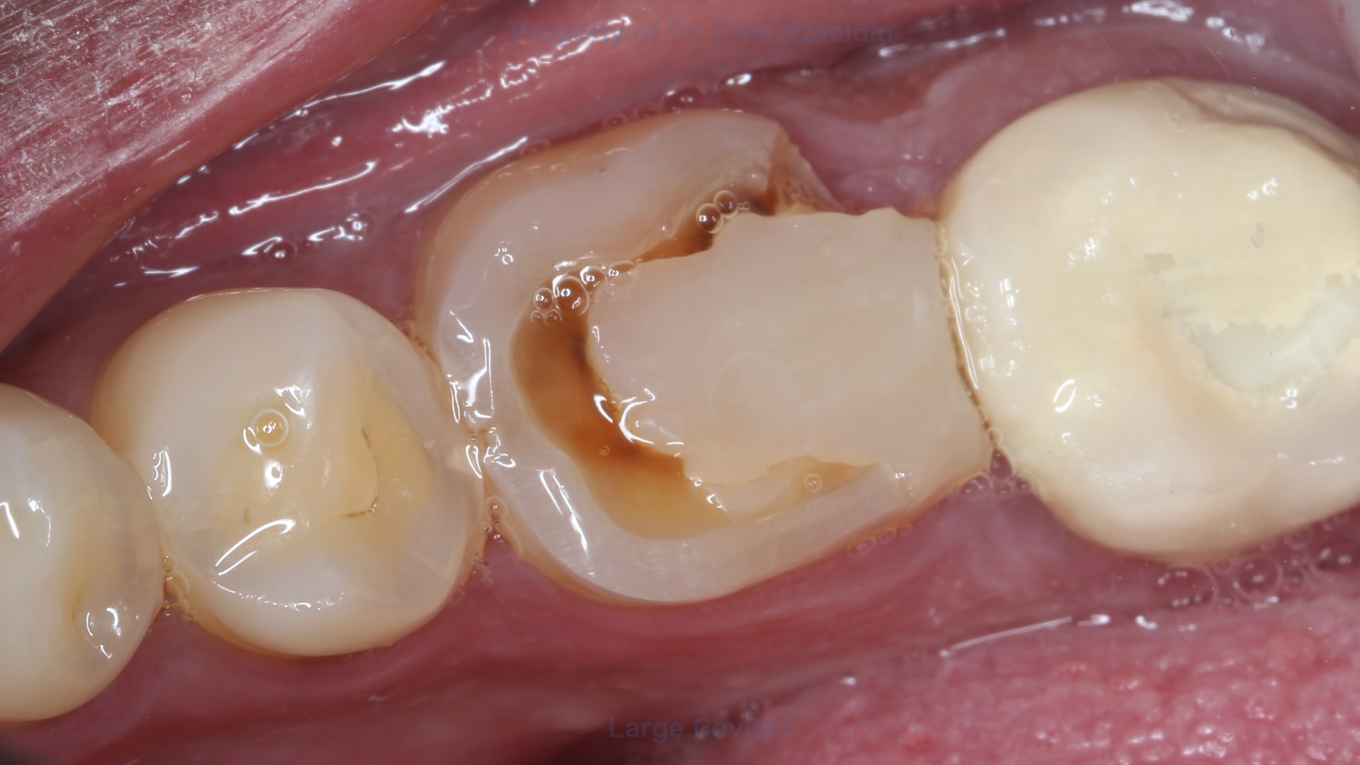 Large Cavity? Picture