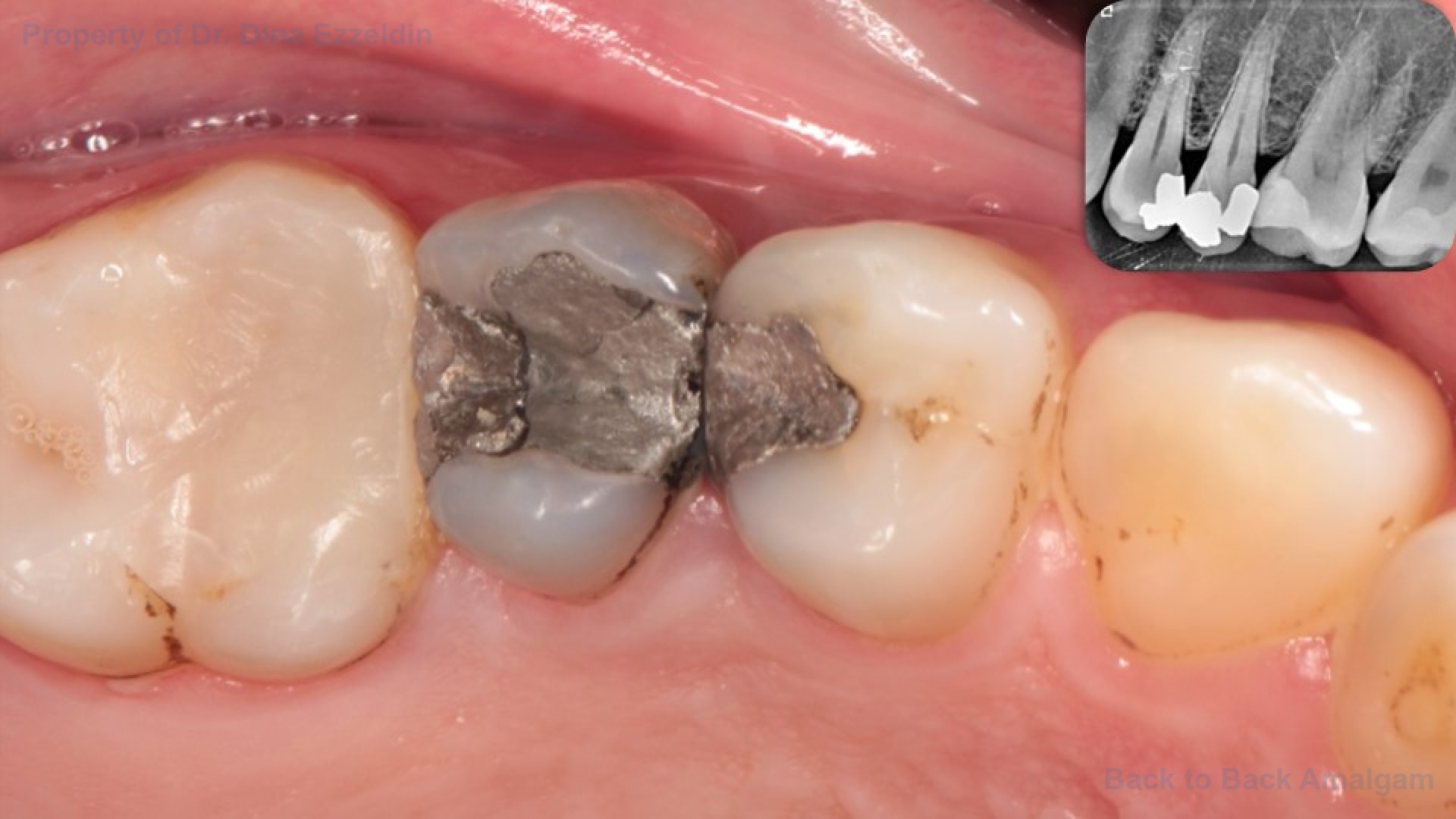 Back to Back Amalgam Picture