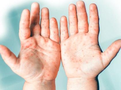 А вдруг это энтеровирус?