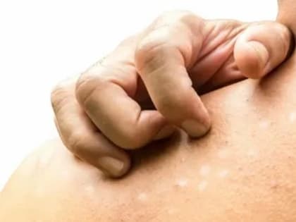 Кожные проявления сахарного диабета