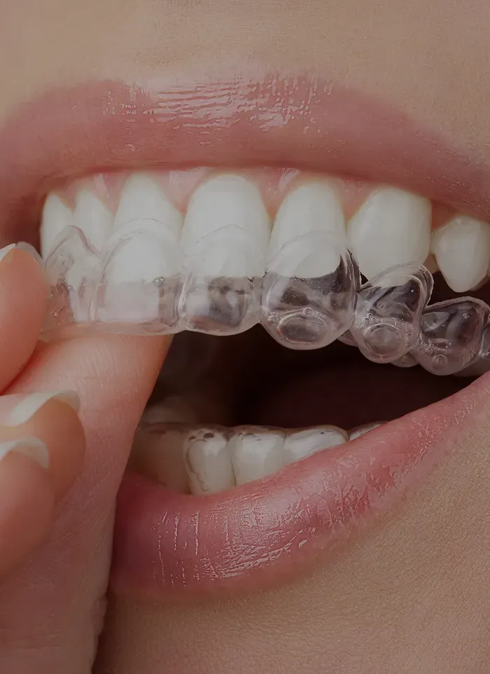 Orthodontie Adultes