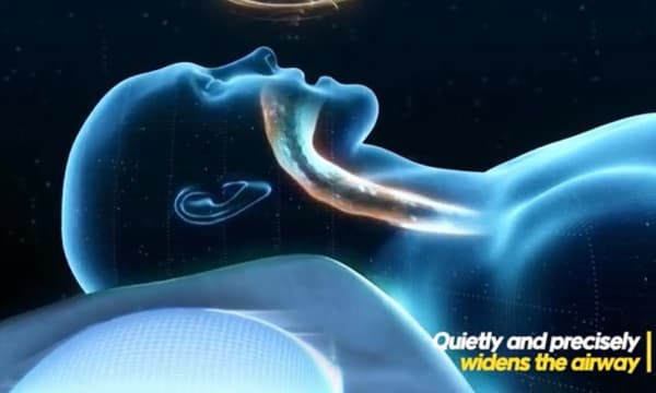 A digital image of a person sleeping. Their airway is lit up with a yellow hue to indicate it is open.