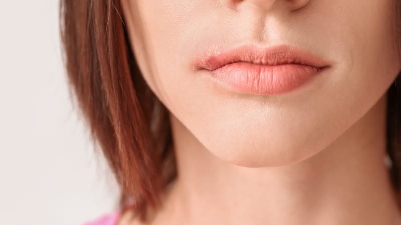 Ajakherpesz ellen természetesen