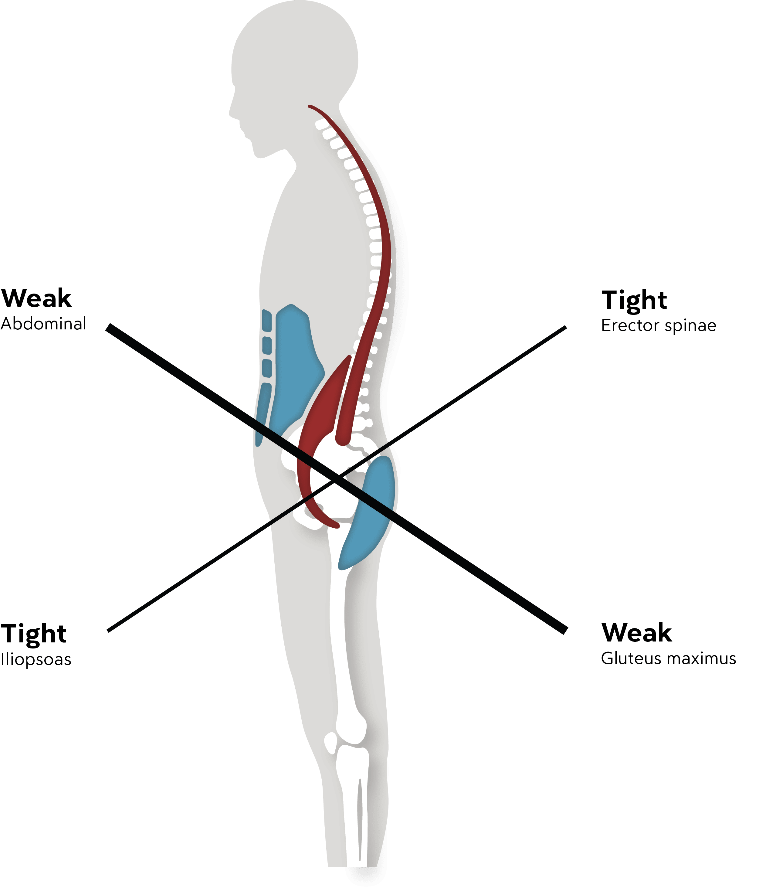 Anthros_LowerCrossedSyndrome