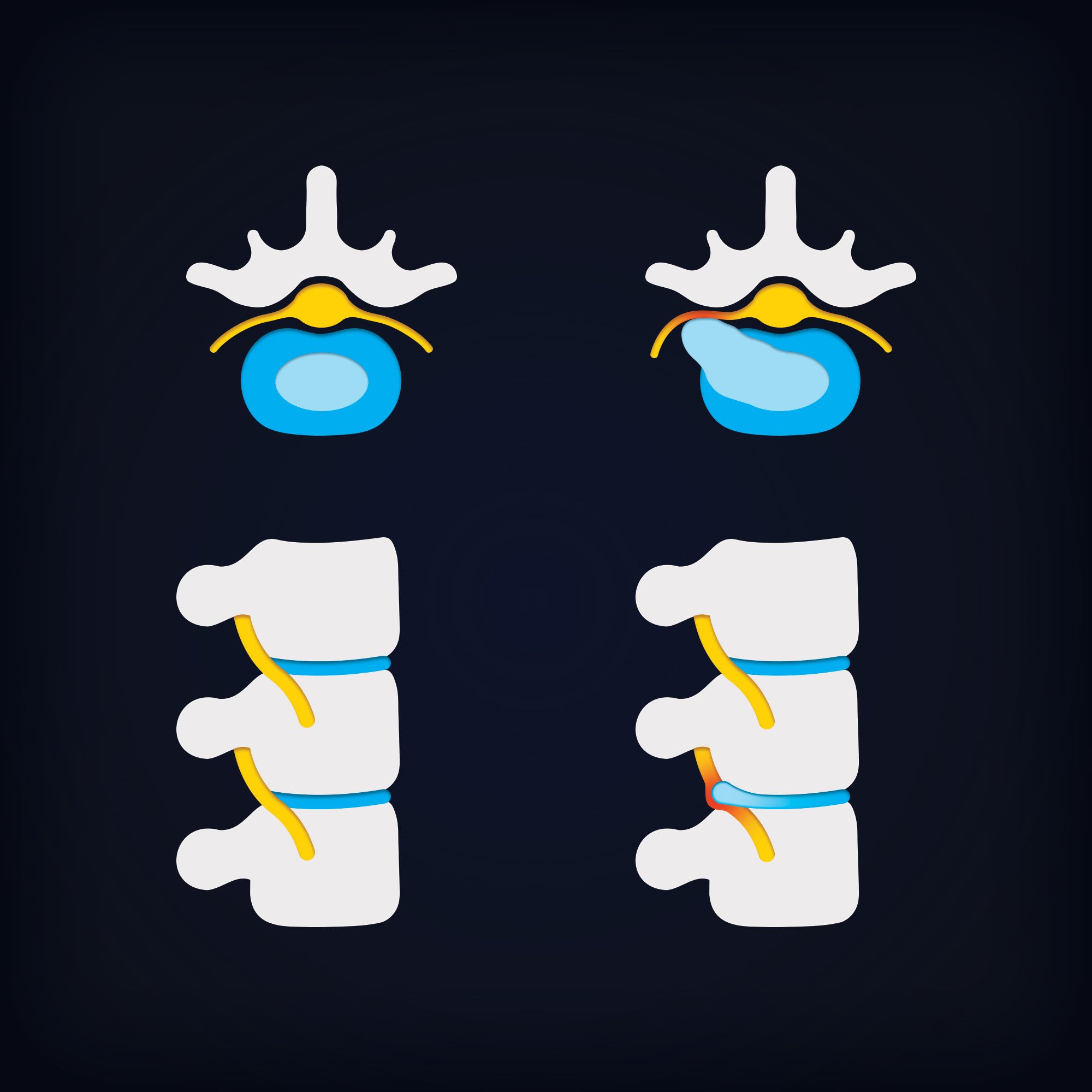 Preview image for How to Prevent Herniated Discs