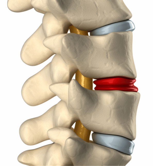 Spinal-stenosis-img1