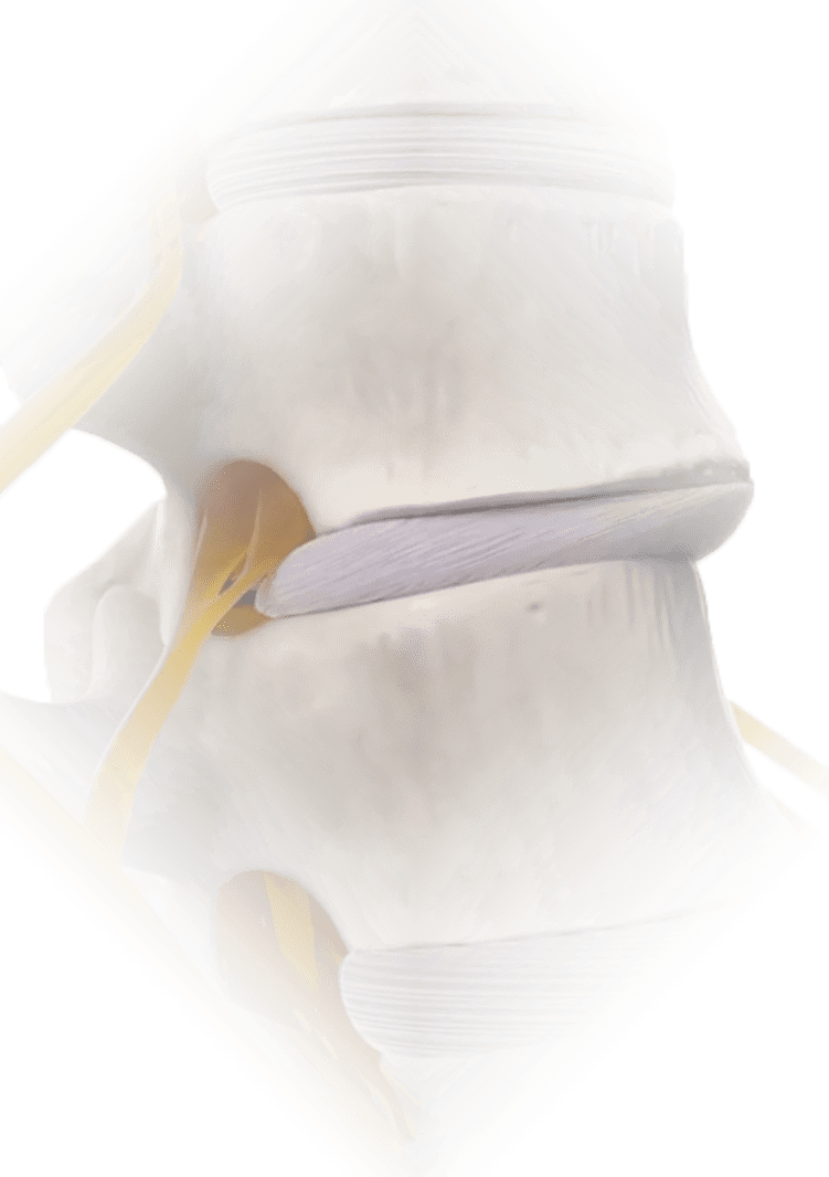 Spondylolisthesis