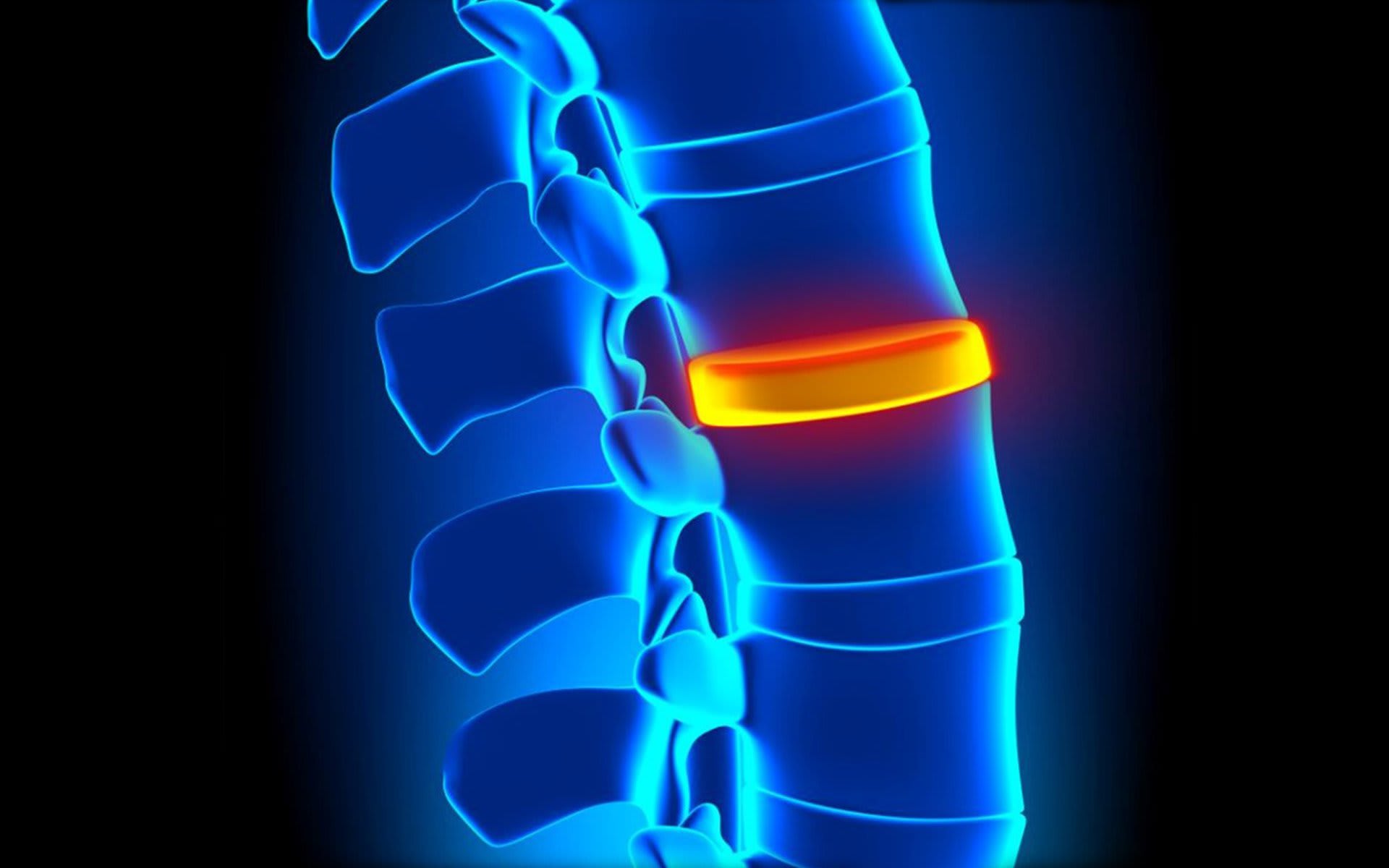 Preview image for Can Poor Posture Increase The Risk Of Disc Degeneration?