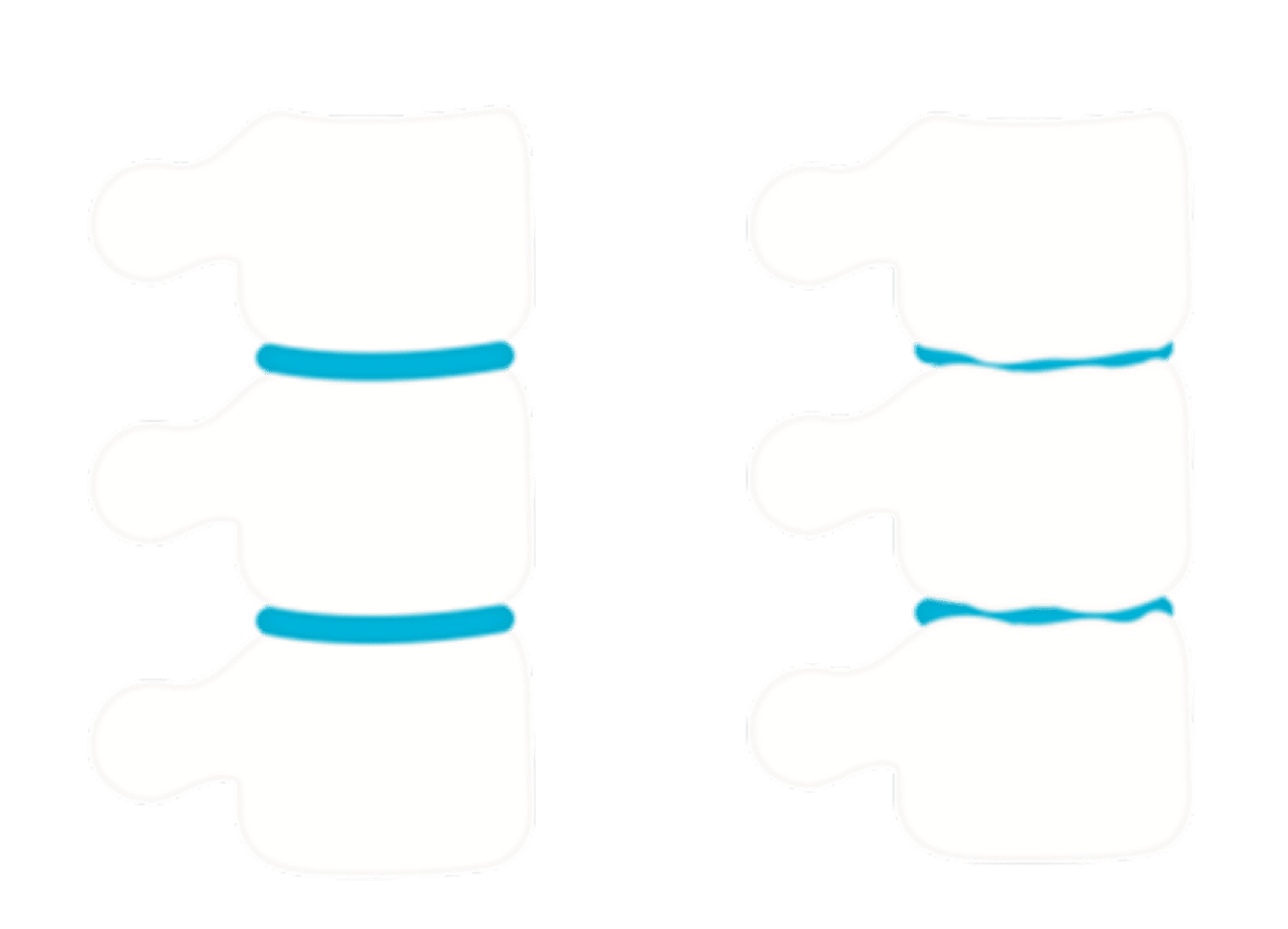 disc-degeneration-img1-new