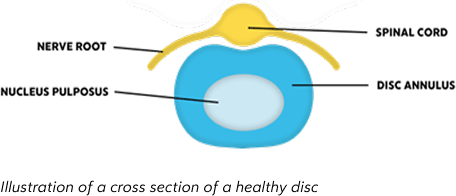 disc-degeneration-img2-new