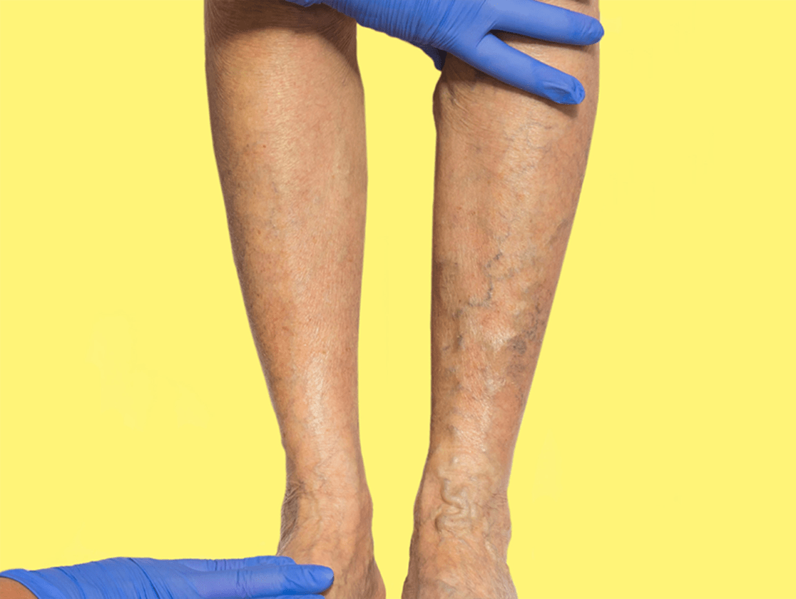 Preview image for Venous insufficiency