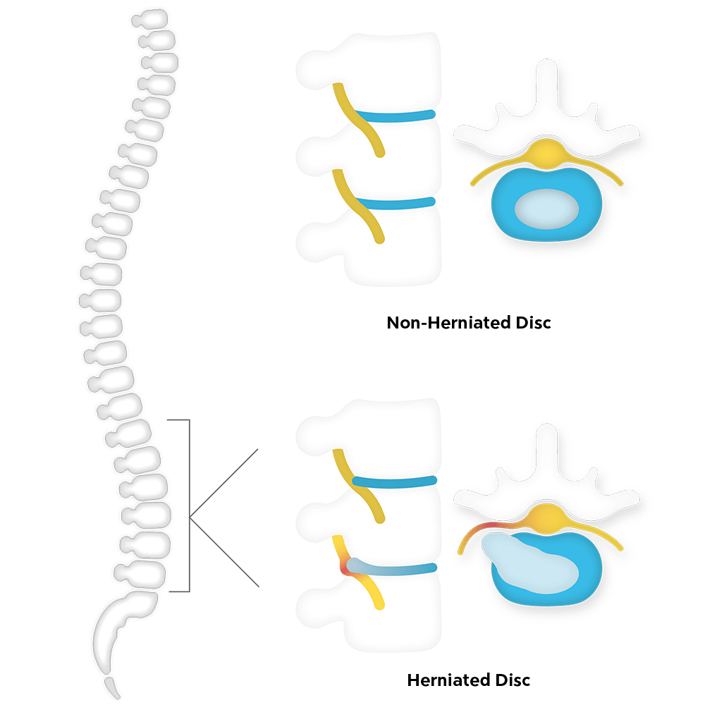 herniated-disc-img