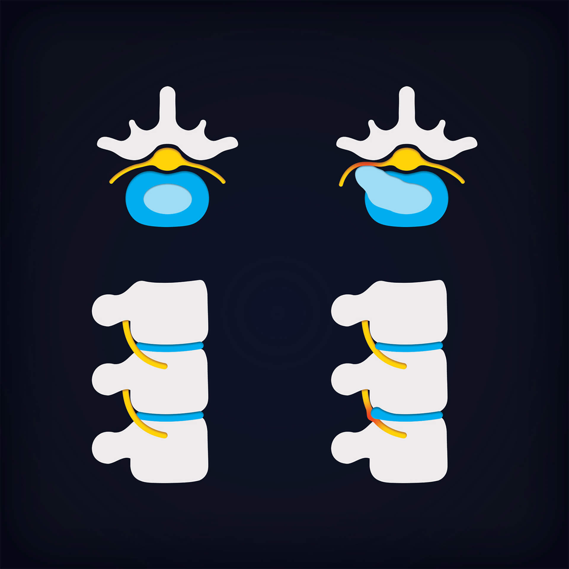 Preview image for Healing Your Lower Back: Exercises for a Herniated Disc