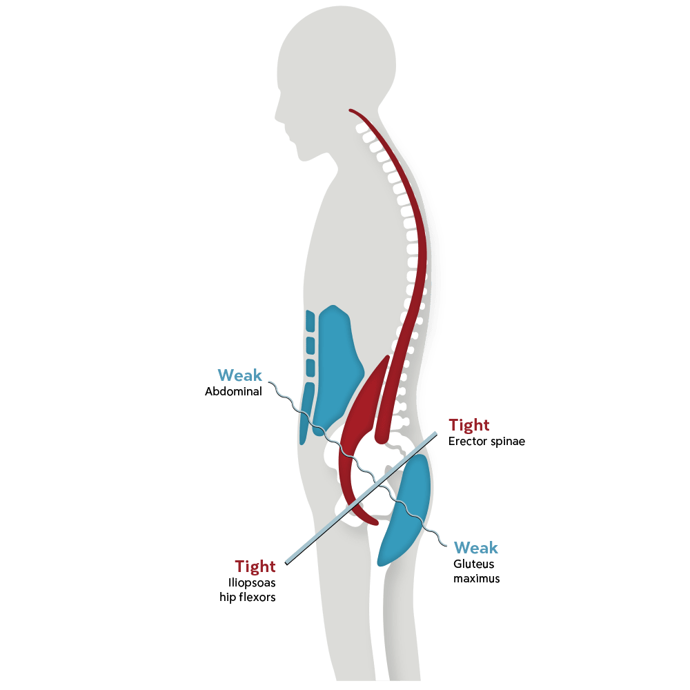 lower-muscle-imbalance