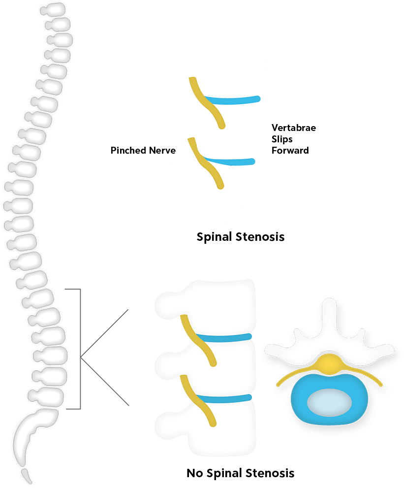 spinal-stenosis