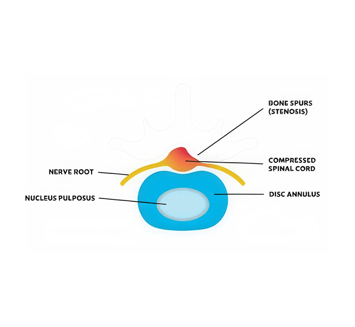 spinal-sterosis-img1