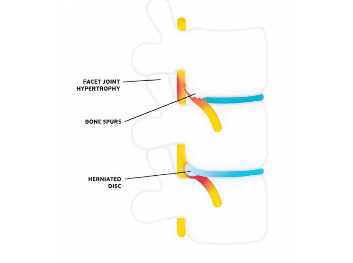 spinal-sterosis-img2