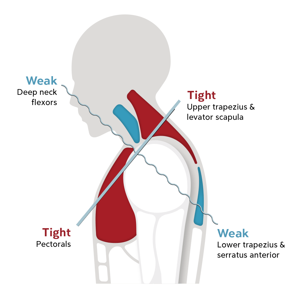 upper-muscle-imbalance